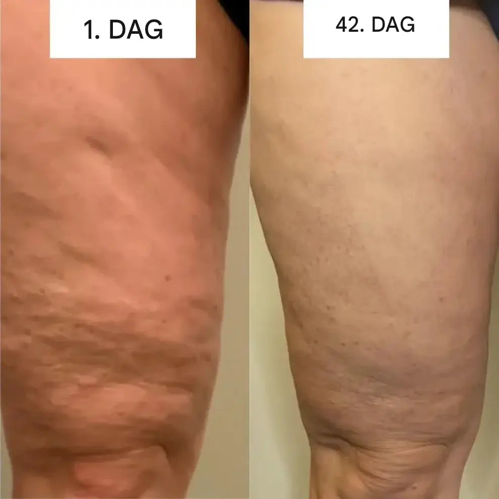 GlowCup – Cellulite Remover och Hudåtstramning med Rödljus och Koppningsterapi