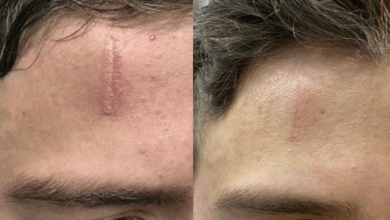 Luviva - Bandes de silicone avancées pour<tamp>le traitement des cicatrices et des rides</tamp>